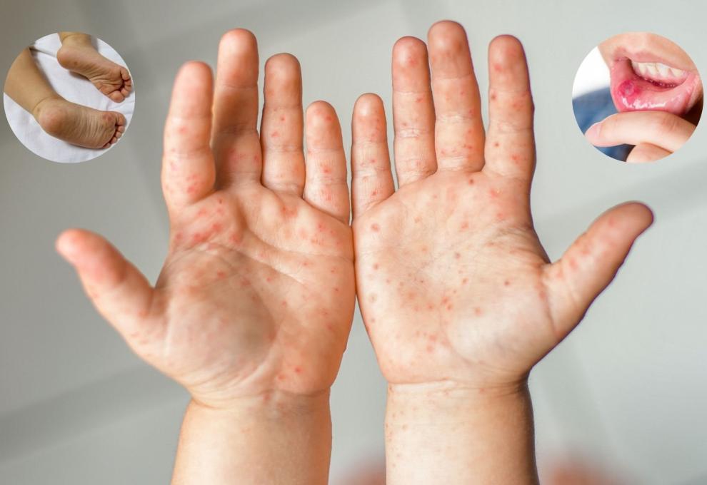 Bộ Y tế yêu cầu các bệnh viện tăng cường năng lực điều trị bệnh tay chân miệng