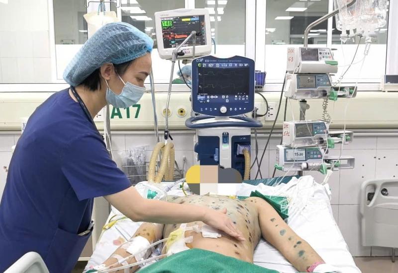 Gia tăng ca mắc thủy đậu, cảnh báo nguy cơ biến chứng nặng